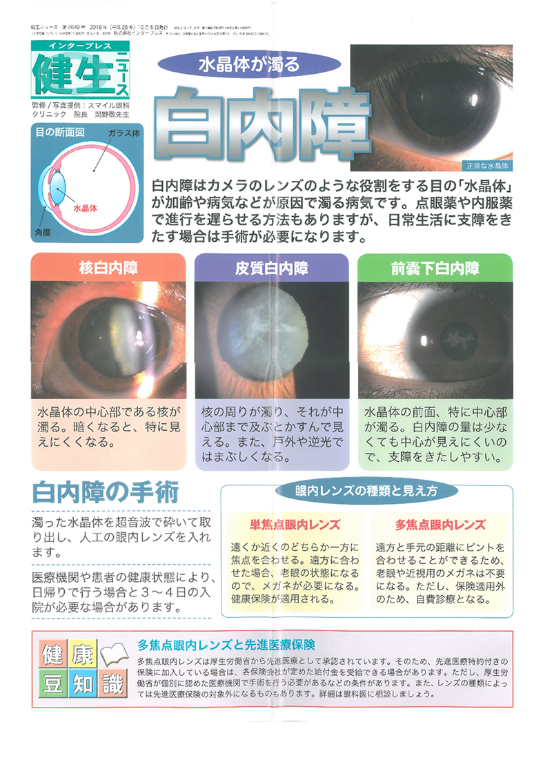 水晶体が濁る「白内障」