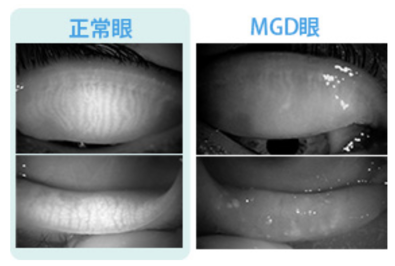 正常なマイボーム腺とマイボーム腺機能不全（MGD）の比較