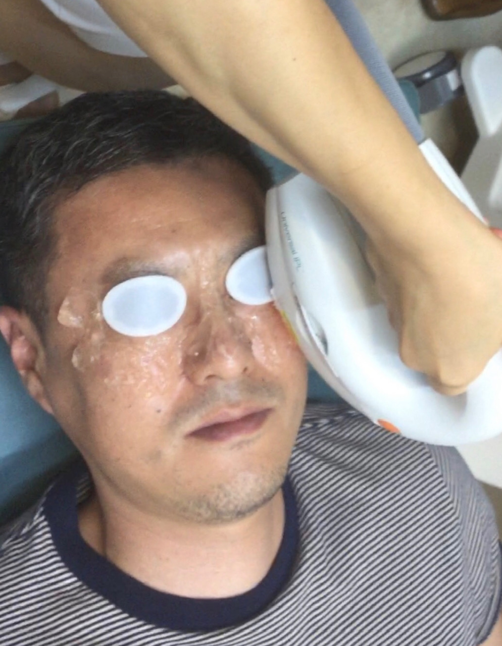 IPLを照射している施術の様子
