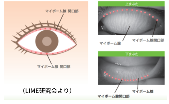 図：マイボーム線開口部の上まぶたと下まぶた：LIME研究会より