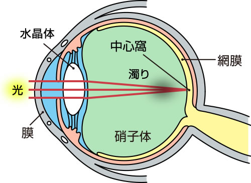 硝子体の濁り