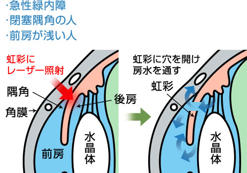 レーザー手術