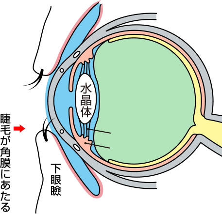 睫毛乱生とは？