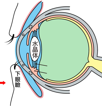 睫毛乱生とは？