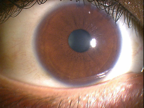 正常な角膜の透明度
