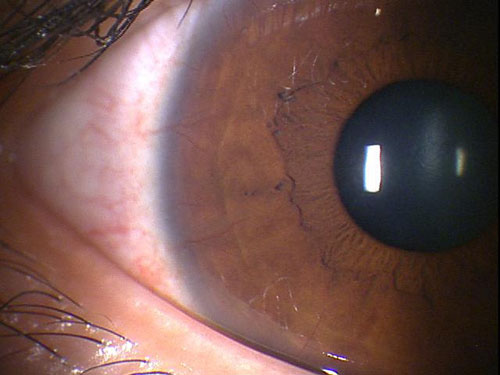 瞳孔にかかる間際まで血管が侵入